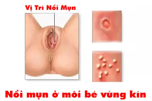 Cách khắc phục khi bị nổi mụn ở môi bé vùng kín