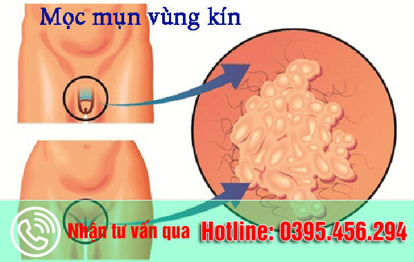 Nổi mụn thịt ở vùng kín nữ giới có thể là bệnh Mụn Rộp Sinh Dục