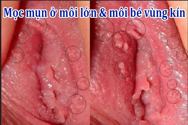 Hình ảnh nổi mụn thịt nguyên nhân do bệnh sùi mào gà