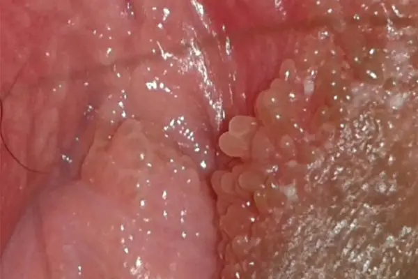 Hình ảnh Vùng kín bị nổi mụn ở nữ giới do gai sinh dục