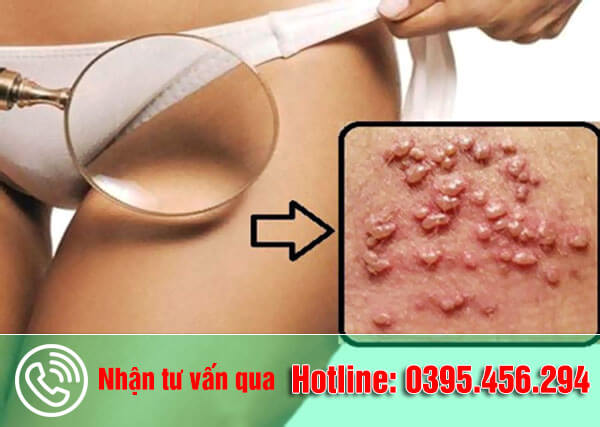 Nổi mụn thịt ở vùng kín nữ giới có thể là bệnh gì? Nguy hiểm không?