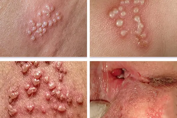 Hình ảnh mụn rộp sinh dục gây nổi mụn mủ ở vùng kín nữ