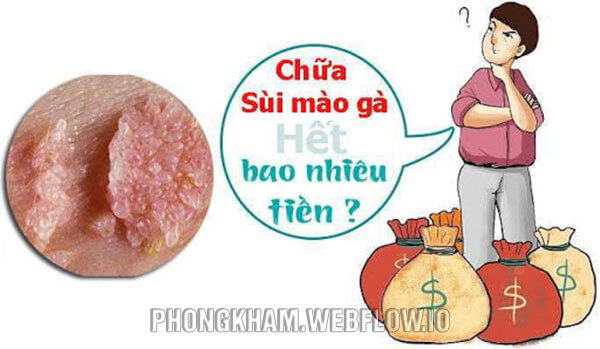 Chi phí chữa sùi mào gà hết bao nhiêu tiền