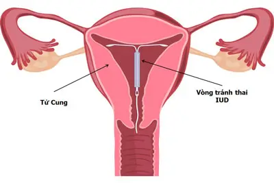 Dấu hiệu đặt vòng thành công BS Trần Thị Thành Tư Vấn