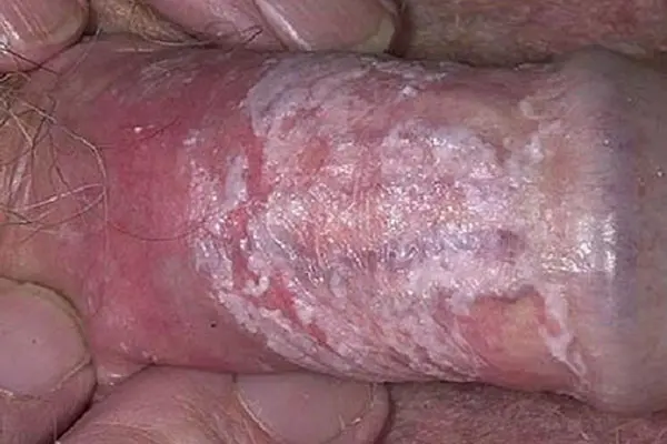 Cần làm gì khi thấy dương vật bị tróc da và ngứa?