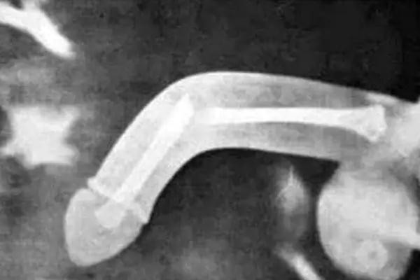 Cách xử lý khi nam giới bị gãy dương vật