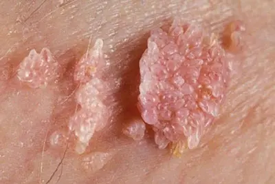 Hình ảnh bệnh sùi mào gà ở nam, nữ giới ở bộ phận sinh dục từ lúc mới bị