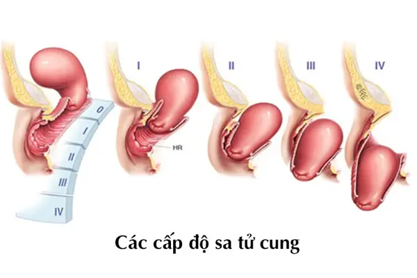 Hình ảnh cục thịt thừa ở vùng kín sau sinh do sa tử cung (sa âm đạo)