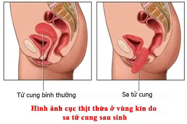 Hình ảnh cục thịt thừa ở vùng kín do sa tử cung sau sinh