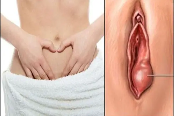 99+ Hình ảnh cục thịt thừa ở vùng kín cách chữa trị hiệu quả