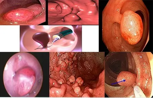 Hình ảnh cục thịt thừa ở vùng kín ở cửa mình