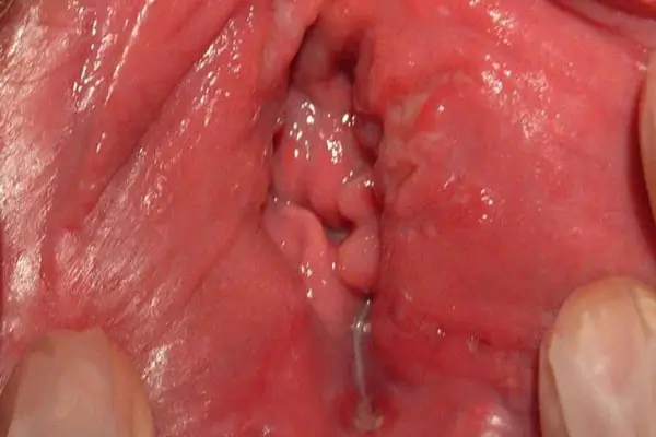 Bệnh viêm âm đạo là nguyên nhân vùng kín nổi mụn thịt