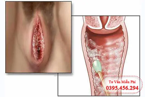 Hình ảnh cục thịt thừa ở vùng kín nấm