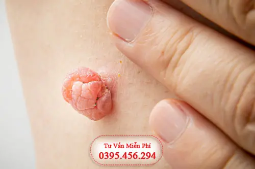 Hình ảnh cục thịt thừa ở vùng kín do mụn thịt