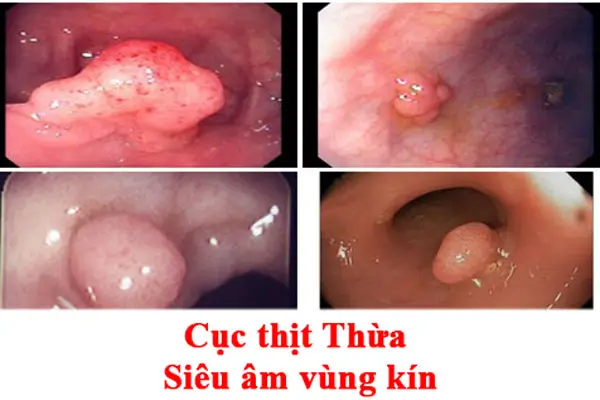 Hình ảnh cục thịt thừa ở vùng kín