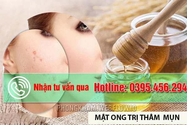 Trị thâm do mụn bằng mật ong