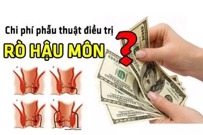 Chi phí phẫu thuật rò hậu môn hết bao nhiêu tiền giá mổ 2026