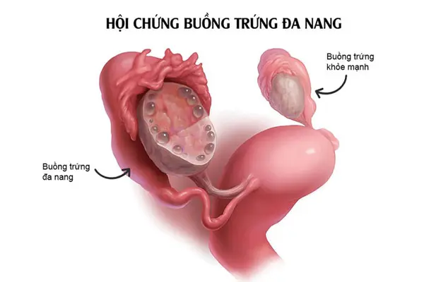 Khái niệm bệnh đa nang buồng trứng là gì?