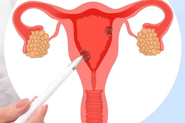 Những nguyên nhân đa nang buồng trứng cần lưu ý