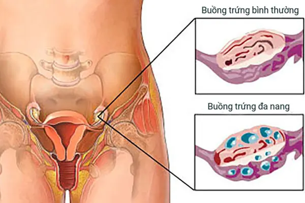Các phương pháp chẩn đoán và điều trị bệnh đa nang buồng trứng