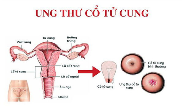 10 dấu hiệu bệnh ung thư cổ tử cung sớm nhất và 5 cách điều trị hiệu quả