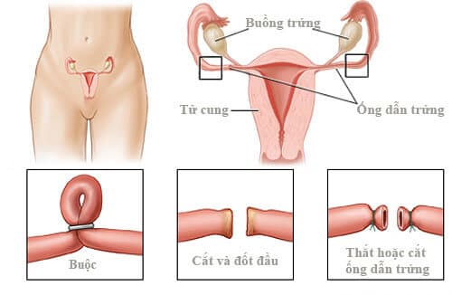 Chữa tắc vòi trứng tại phòng khám Đa Khoa Hưng Thịnh