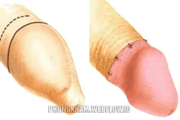 Thế nào gọi là bao quy đầu dài?