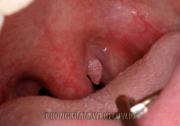 Sùi mào gà ở họng