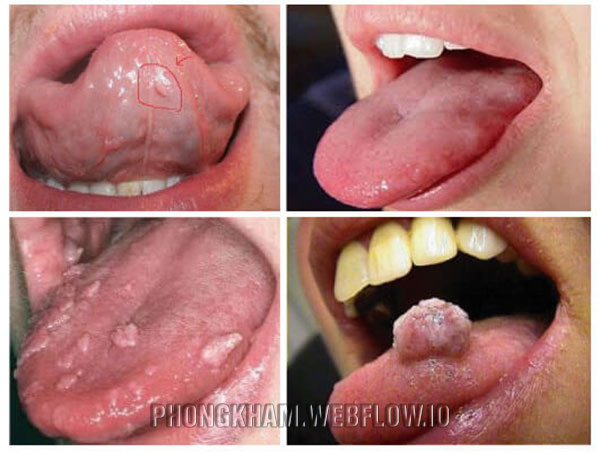 Cách điều trị sùi mào gà ở lưỡi