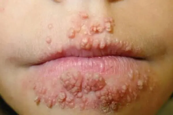 Hình ảnh sùi mào gà ở miệng, lưỡi, họng nam và nữ giới