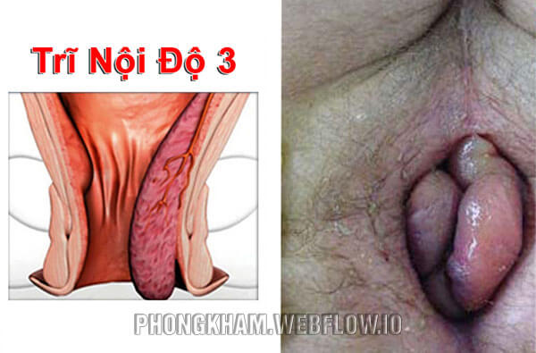 Cấp độ 3: Búi trĩ cứng ở ngoài hậu môn, màu xám và phát triển to hơn lòi hẳn ra bên ngoài
