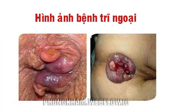 Cấp độ 4 trĩ hỗn hợp dạng nặng