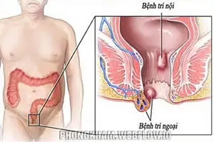 99+ Hình ảnh bệnh trĩ giai đoạn đầu, nhẹ trĩ nội trĩ ngoại ở hậu môn