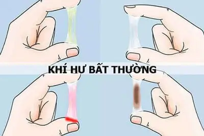 100+ Hình ảnh khí hư bất thường thật ở phụ nữ vàng, xanh, trắng đục