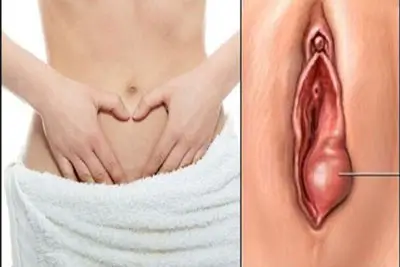 99+ Hình ảnh cục thịt thừa ở vùng kín cách chữa trị hiệu quả