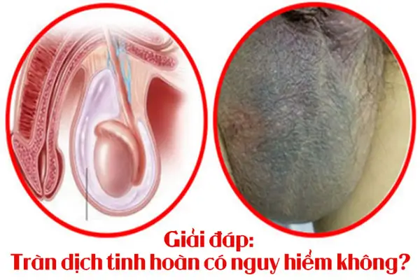 Giải đáp: Tràn dịch tinh hoàn có nguy hiểm không?