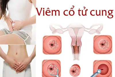 Viêm cổ tử cung có chữa khỏi được không, có nguy hiểm không?