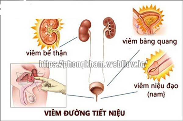 viêm đường tiết niệu 10 cách điều trị hiệu quả nhất
