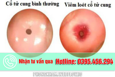 Viêm loét cổ tử cung nguyên nhân triệu chứng cách phòng bệnh hiệu quả