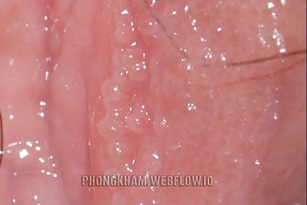 Hình ảnh mụn cóc sinh dục ở nữ giới qua từng giai đoạn