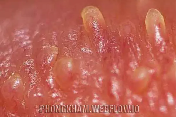 Hình ảnh mụn cóc sinh dục ở nữ tại một số vị trí khác