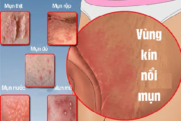 Cách chữa nổi mụn ở vùng kín nam, nữ giới hiệu quả