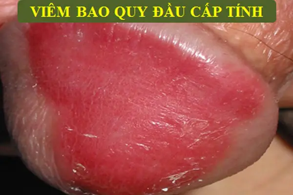 Hình ảnh viêm bao quy đầu ở nam giới giai đoạn cấp tính