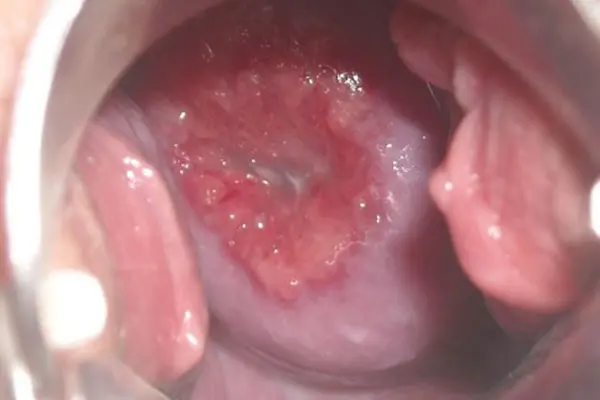 Hình ảnh viêm cổ tử cung ảnh thật