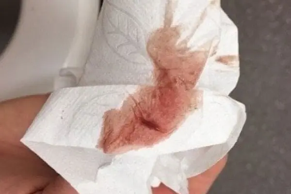 Hình ảnh máu báo thai thật 3