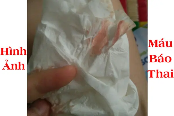 Hình ảnh máu báo thai thật 2