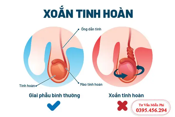Cách chữa trị xoắn tinh hoàn hiệu quả