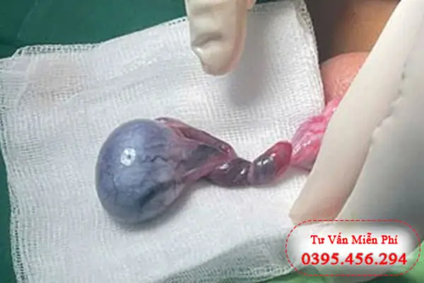 Hình ảnh xoắn tinh hoàn thật cụ thể ở nam giới