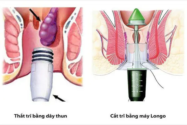Review Phương pháp cắt trĩ Longo
