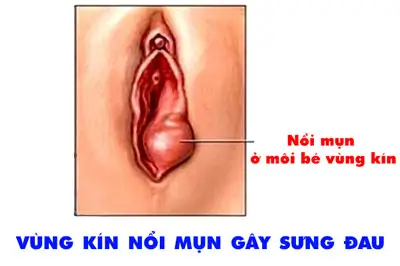 Nổi mụn ở môi bé vùng kín hình ảnh nguyên nhân cách khắc phục